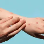 Pharmacist Can Positively Influence Mpox Vaccinations