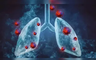 HMPV cases being circulated in Pakistan for two decades: NIH