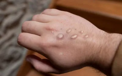 Pakistan reports first case of Monkeypox in 2025