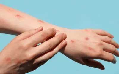 First locally transmitted Mpox case reported in KP