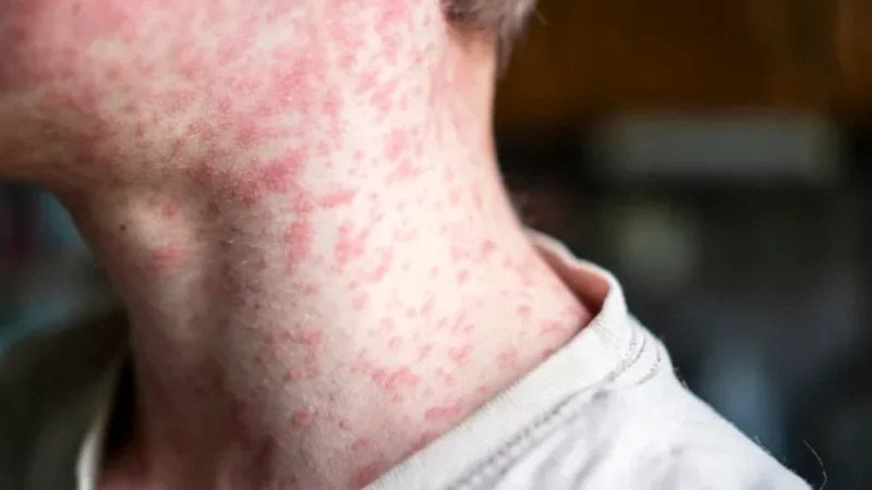 Measles cases surge in Karachi and SindhMeasles cases surge in Karachi and Sindh