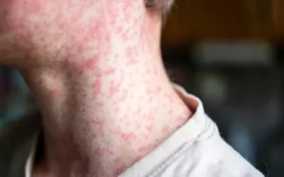 Pennsylvania faces measles surge as cases soar to 903