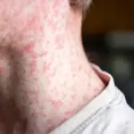Pennsylvania faces measles surge as cases soar to 903