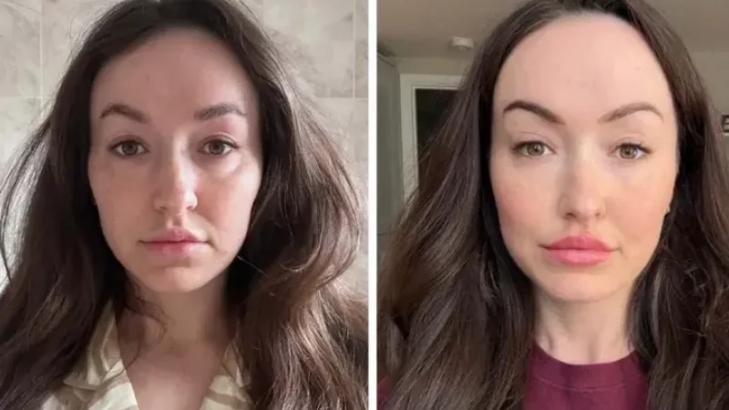 ‘Ferritin face’ goes viral as doctors warn against self-diagnosis - content creators, Ferritin face, pale skin, social media