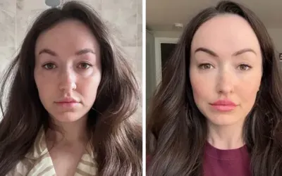 ‘Ferritin face’ goes viral as doctors warn against self-diagnosis