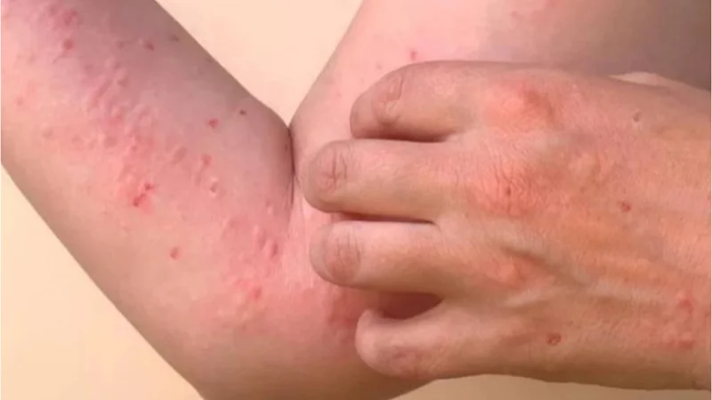 Chikungunya cases rate increase in Karachi