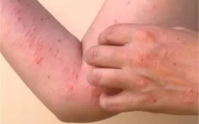 NIH issues health advisory about Chikungunya