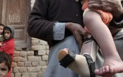 Another polio case reported in Karachi