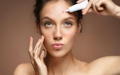 6 common medications that can trigger ‘Acne’ breakouts, experts say