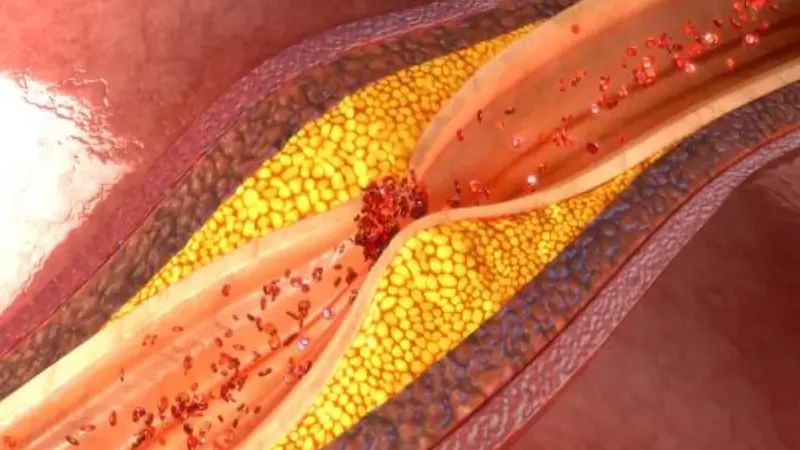 Here's how to reduce fat in arteries