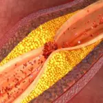 Here's how to reduce fat in arteries