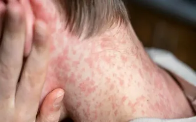 1695 suspected measles cases reported in Punjab
