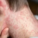 1695 suspected measles cases reported in Punjab