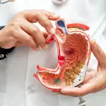 Stomach Cancer: Symptoms and Treatment