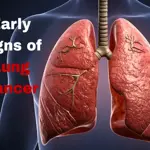 Five early signs of lung cancer