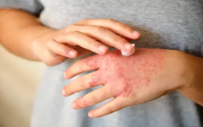 Here's everything you need to know about Eczema