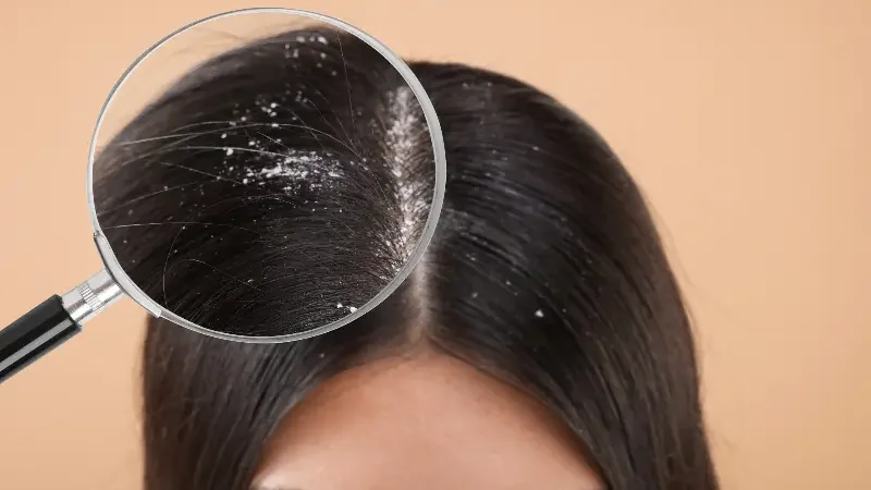 Here's how can you treat dandruff