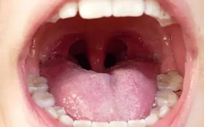 What are tonsil stones? Symptoms, causes, diagnosis, treatment, and prevention