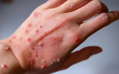 Mpox case confirmed in Karachi: Alert issued by Sindh