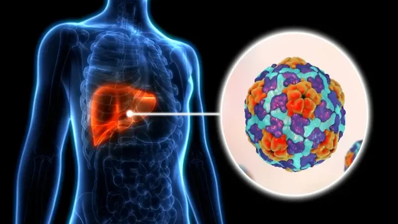 Hepatitis A: Symptoms, causes, diagnosis, treatment, and prevention