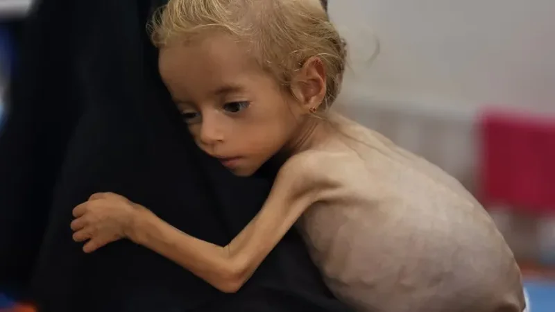 Malnutrition