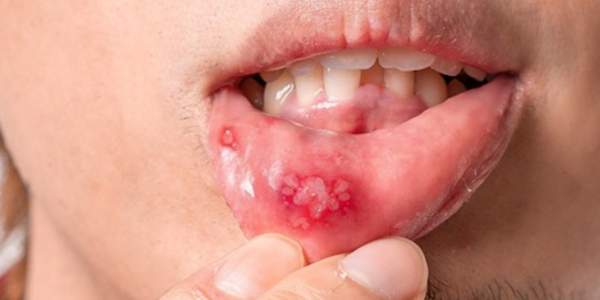 منہ میں چھالے