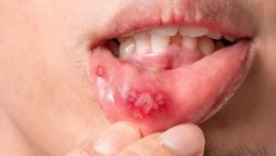 منہ میں چھالے