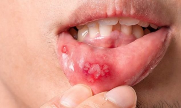 منہ میں چھالے