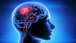 چار ماہ سے ہچکیاں لینے والے فرد میں دماغی رسولی کی تشخیص