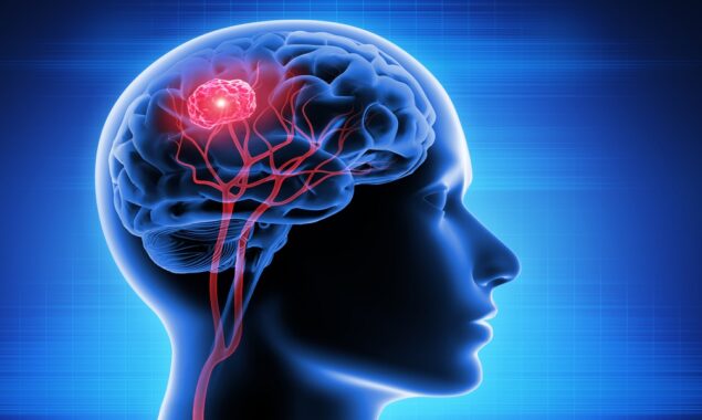 چار ماہ سے ہچکیاں لینے والے فرد میں دماغی رسولی کی تشخیص