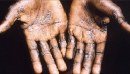 Monkeypox