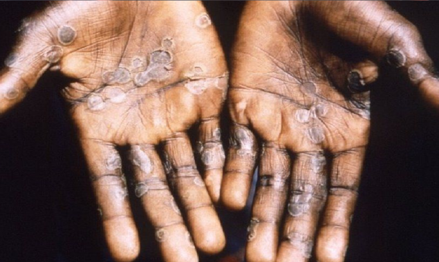 Monkeypox