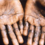 Monkeypox