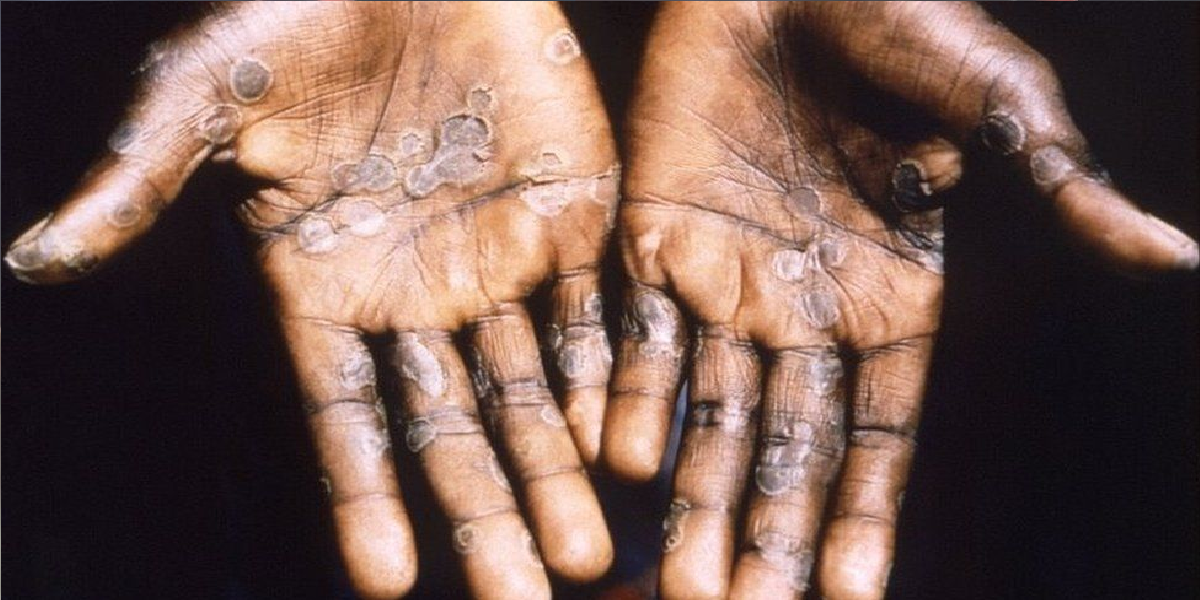 Monkeypox