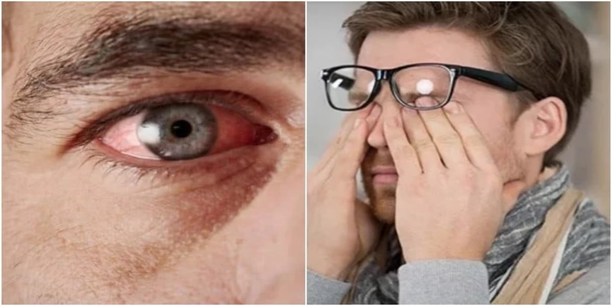 آنکھیں مسلنا