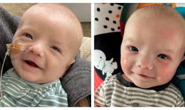 دل کی جزوی پیوندکاری حاصل کرنے والا بچہ ایک برس بعد بھی تندرست و توانا