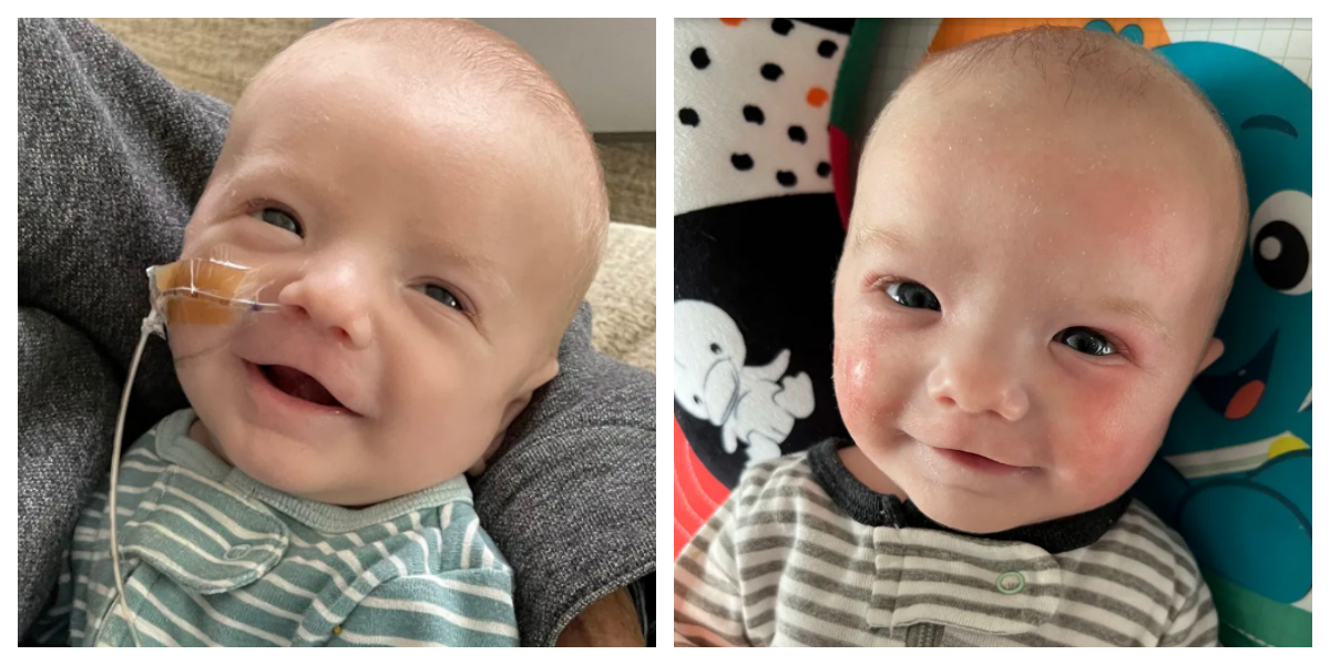 دل کی جزوی پیوندکاری حاصل کرنے والا بچہ ایک برس بعد بھی تندرست و توانا