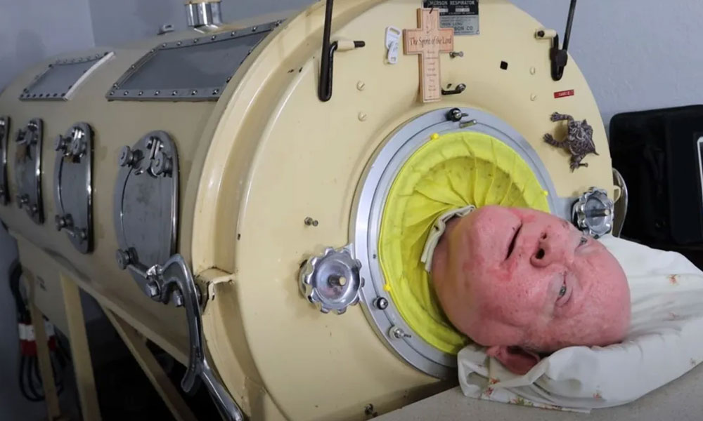 72 سال لوہے کے پھیپھڑے میں رہنے والا شخص چل بسا