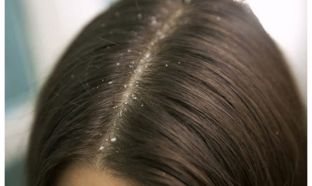 سرسوں کے تیل میں صرف یہ ایک جز ملائیں، بالوں کی خشکی سے نجات پائیں