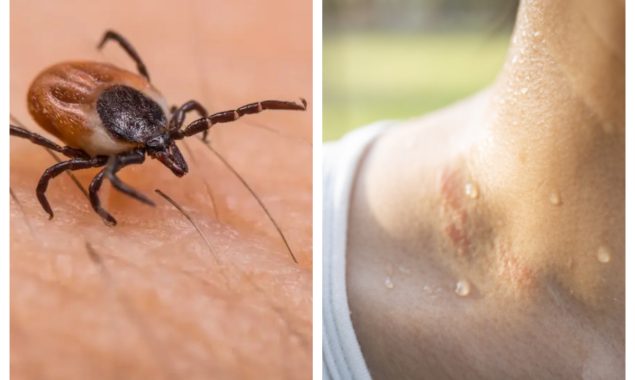 انسانی پسینے میں لائم مرض کے خلاف اہم کیمیکل دریافت