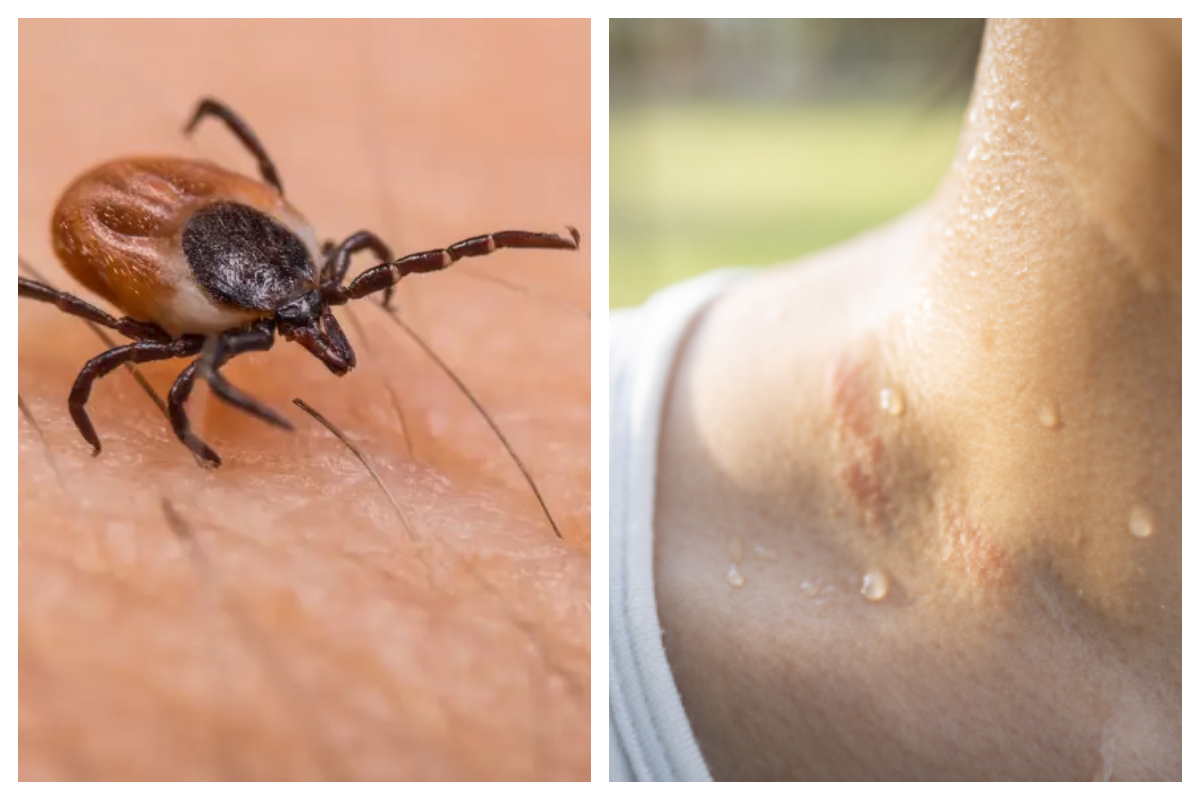 انسانی پسینے میں لائم مرض کے خلاف اہم کیمیکل دریافت