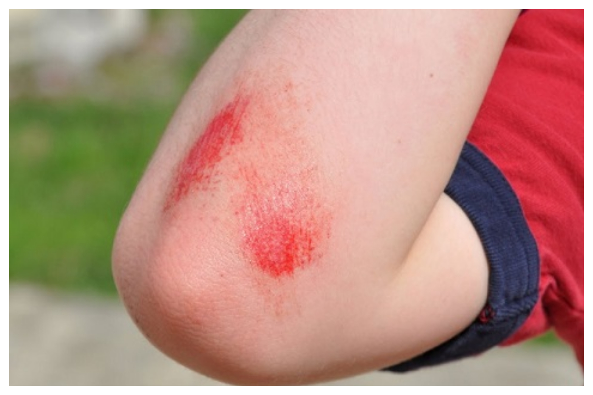 جلد کے زخم اور آنتوں کے درمیان گہرے تعلق کا انکشاف