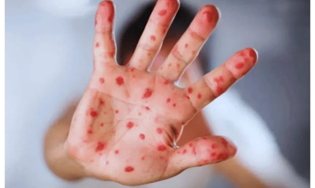 پنجاب میں خسرہ کے بڑھتے کیسز، صوبائی محکمہ صحت متحرک ہوگیا