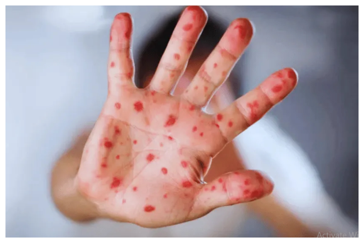 پنجاب میں خسرہ کے بڑھتے کیسز، صوبائی محکمہ صحت متحرک ہوگیا