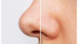 یہ اسکرب لگائیں، صرف 5 منٹ میں بلیک ہیڈز سے نجات پائیں