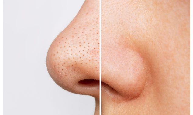 یہ اسکرب لگائیں، صرف 5 منٹ میں بلیک ہیڈز سے نجات پائیں