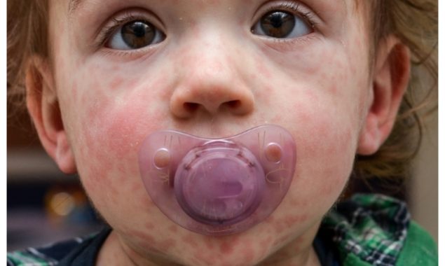 عالمی سطح پر خسرہ کے کیسز میں اضافے کی بڑی وجہ سامنے آگئی