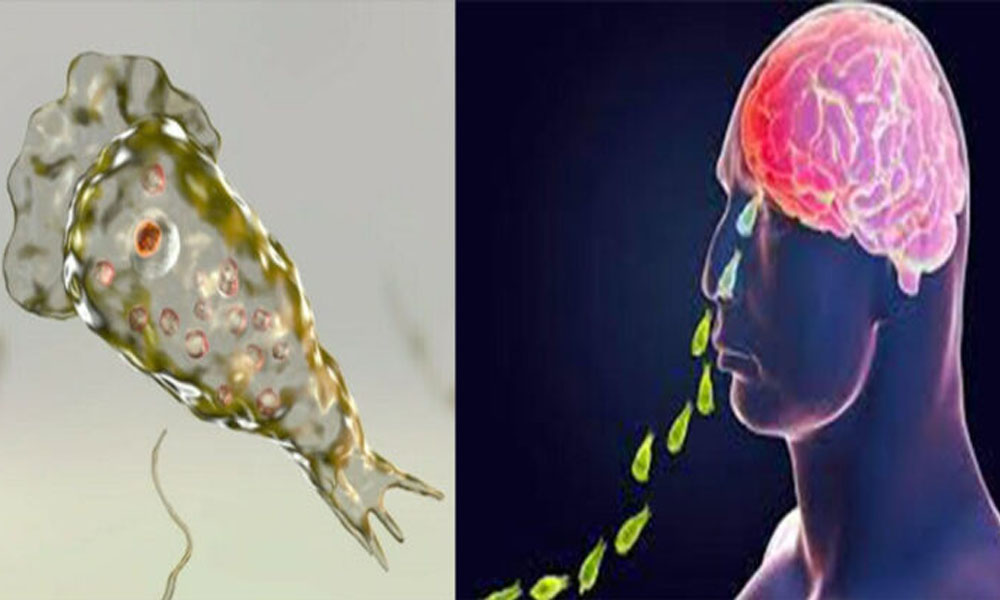 کراچی، خطرے کی گھنٹی بج گئی، خونی نیگلیریا سے ایک شخص ہلاک