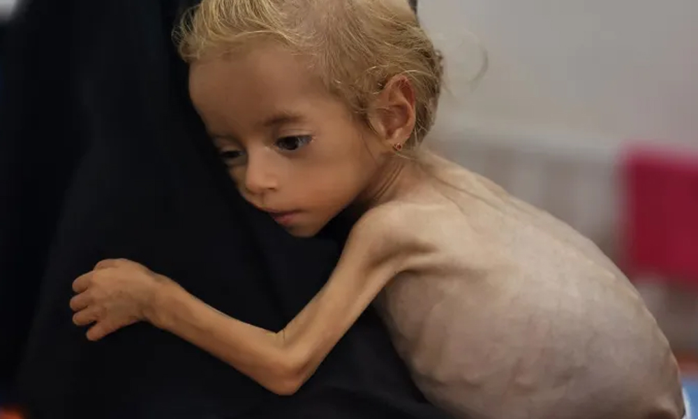 غزہ میں قحط سے دم توڑتے بچوں کی لرزہ خیر کہانی، برطانوی ڈاکٹر کی زبانی