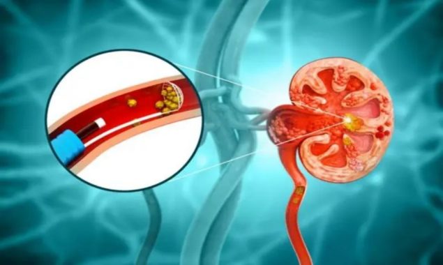 گردے کی پتھری کے علاج میں خوردبینی روبوٹ، نیا انقلابی قدم
